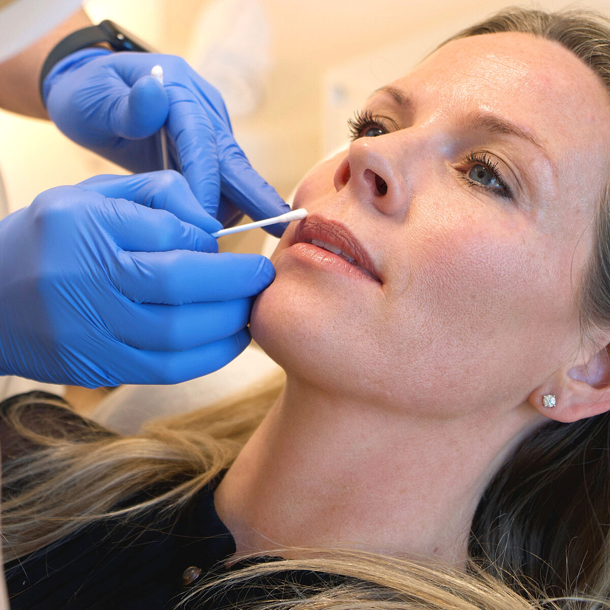 Foto eines Frauengesichts deren Lippen von einem Arzt für die Behandlung mit Hyaluronsäure-Filler vorbereitet werden.