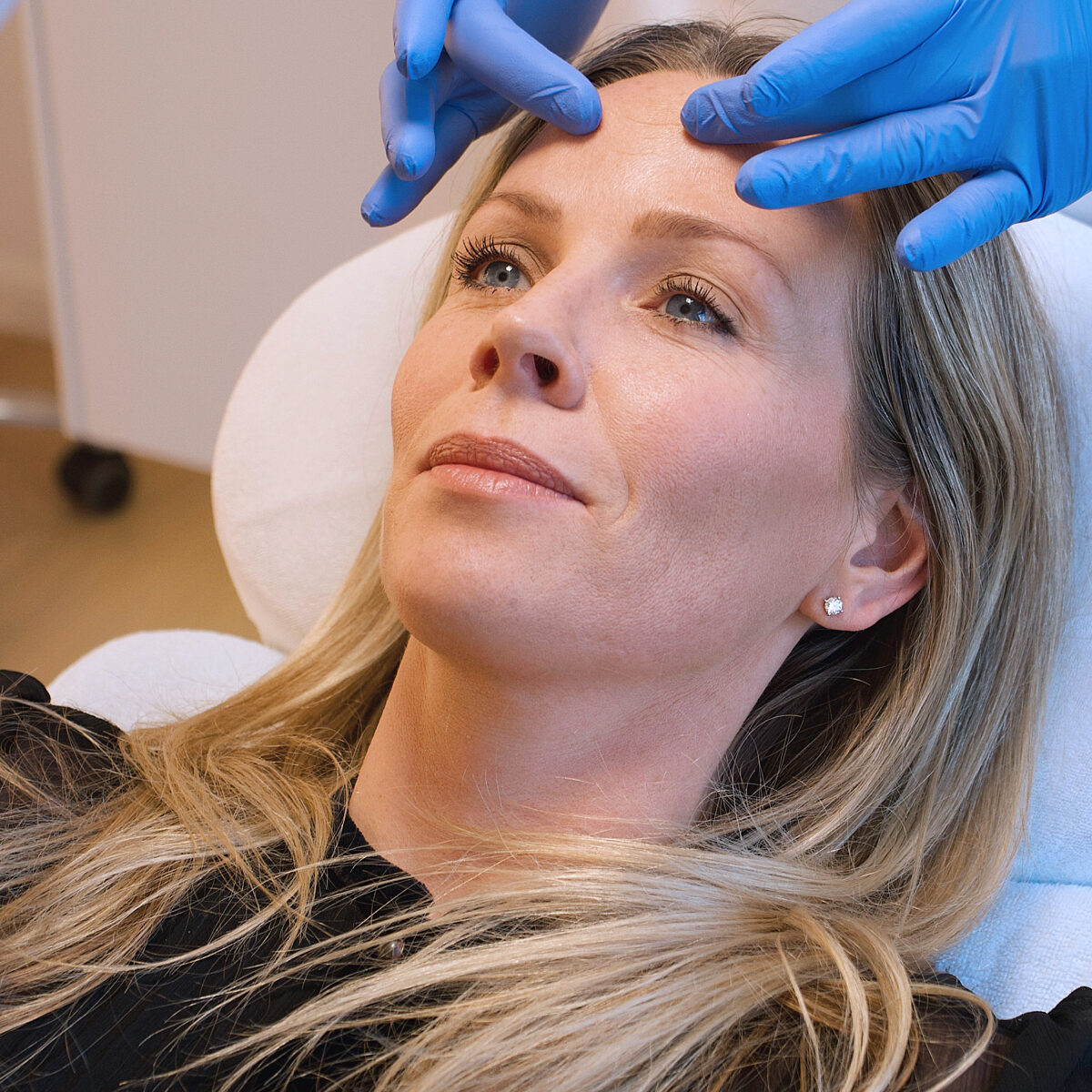 Foto eines Frauengesichts deren Lippen von einem Arzt für die Behandlung mit Hyaluronsäure-Filler vorbereitet werden.