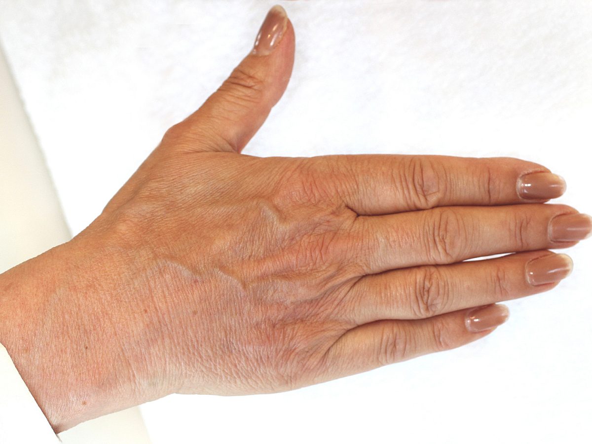 Aufnahme einer Hand nach der Hydrationsbehandlung bei Smoothline