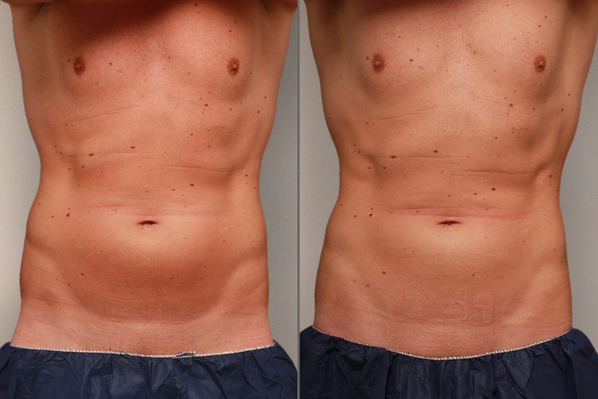 Frontal view of Hannes' abdominal region before and after the CoolSculpting treatment at Smoothline