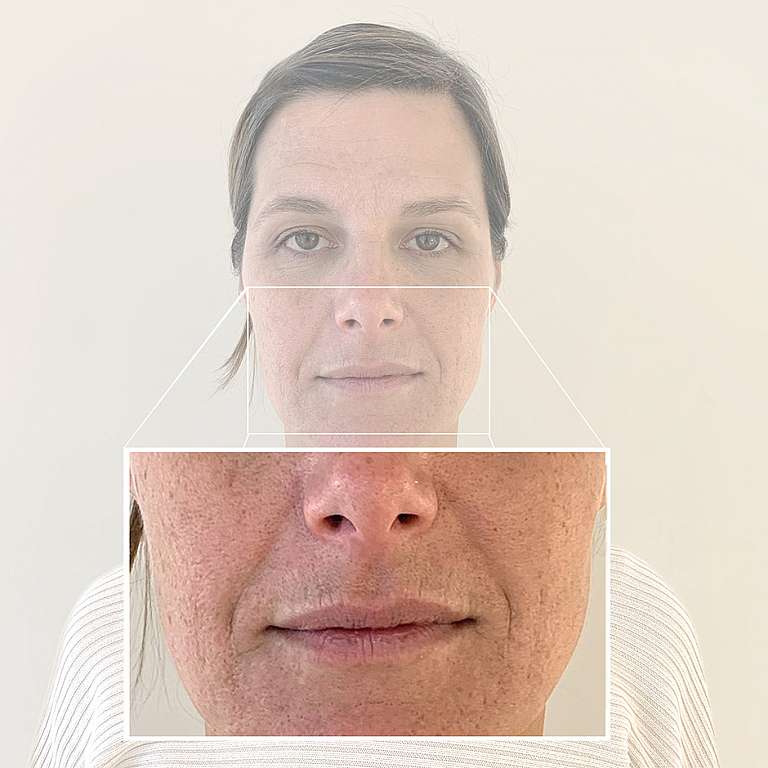 Detail-Foto von Manuelas Gesicht mit Fokus auf ihre Mund- und Nasenregion vor der Behandlung der Nasolabialfalten bei Smoothline