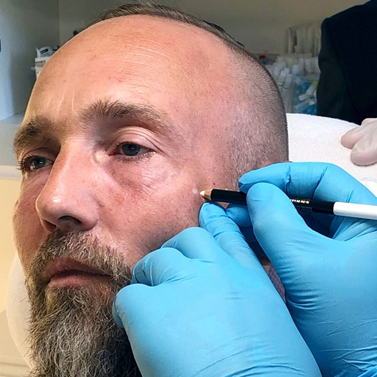 Gesicht von Matthias beim Einzeichnen für die Behandlung des Wangenaufbaus