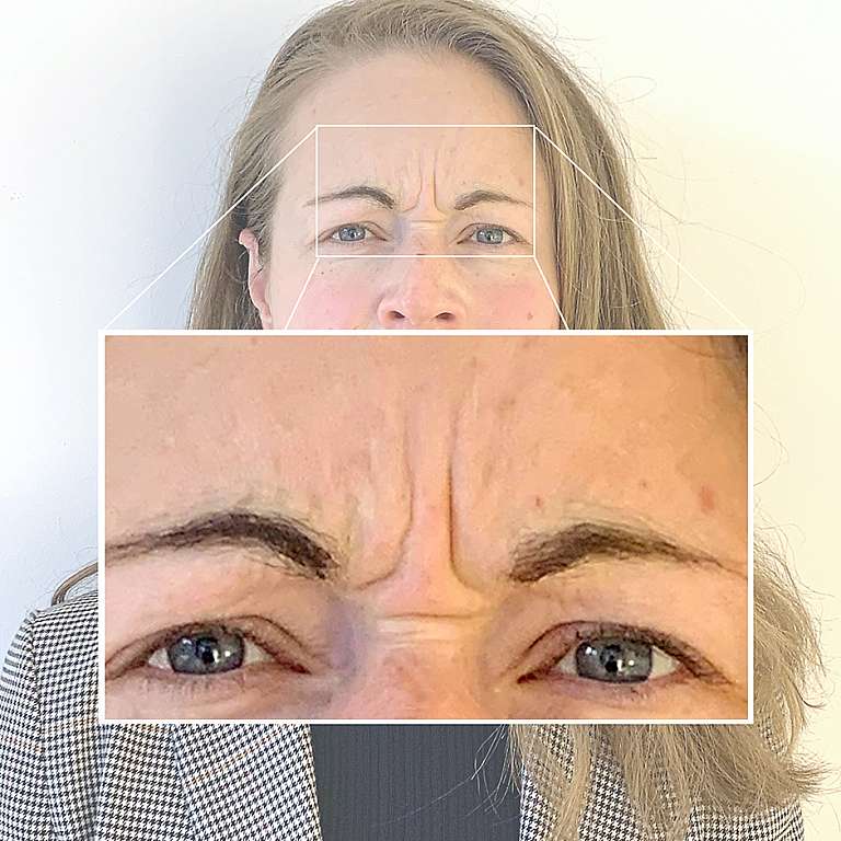 Aufnahme eines Gesichts mit Detailansicht der Augen- und Stirnpartie mit Zornesfalten