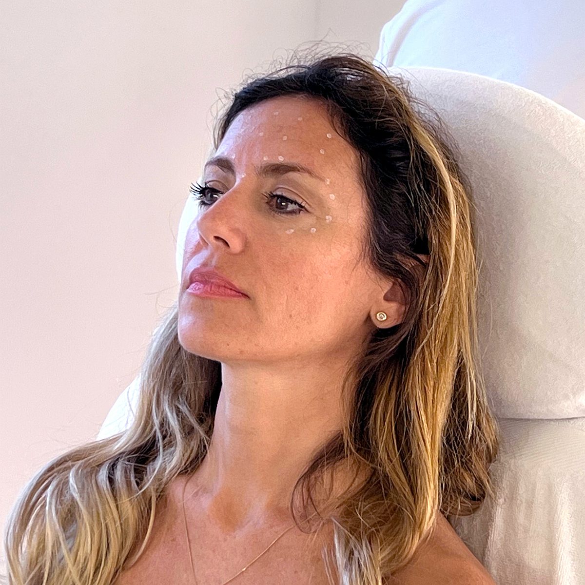 Photo of Silvana's face with the marked areas for treatment with Botulinum toxin