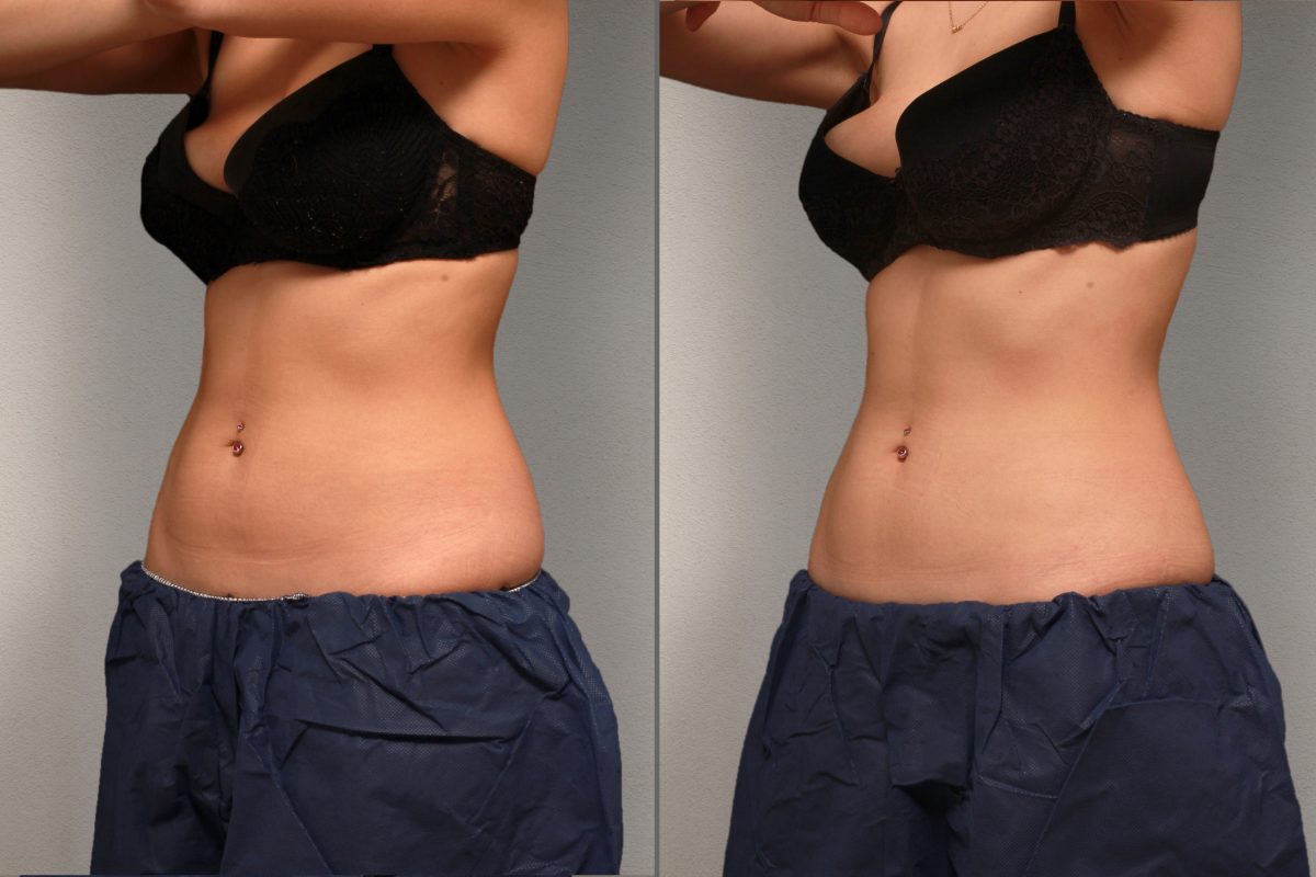 Side view of Sofia's abdominal region before and after the CoolSculpting treatment at Smoothline