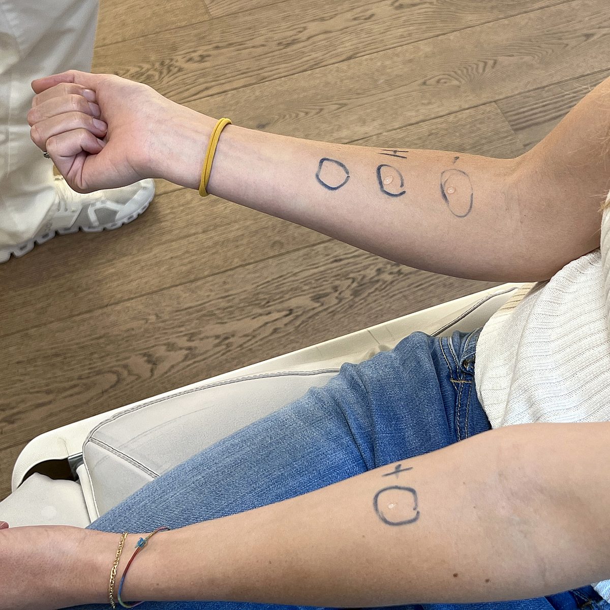 Picture of Stephanie's arms during the allergy test at Smoothline