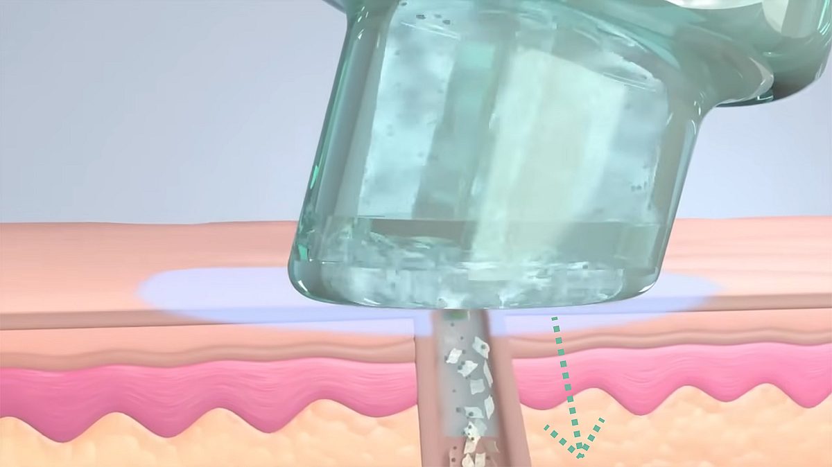 eine Illustration, die den zweiten Schritt der Hydrafacial-Behandlung mit dem Säurepeeling veranschaulicht
