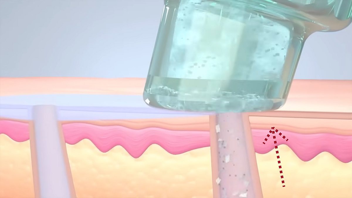 eine Illustration, die den dritten Schritt der Hydrafacial-Behandlung mit der Tiefenausreinigung veranschaulicht