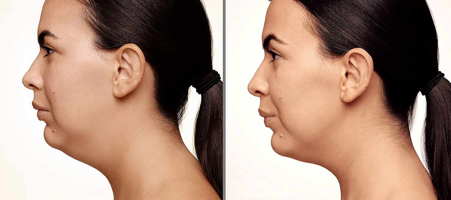 Smoothline CoolSculpting für Fettreduktion Kryolipolyse in Zürich
