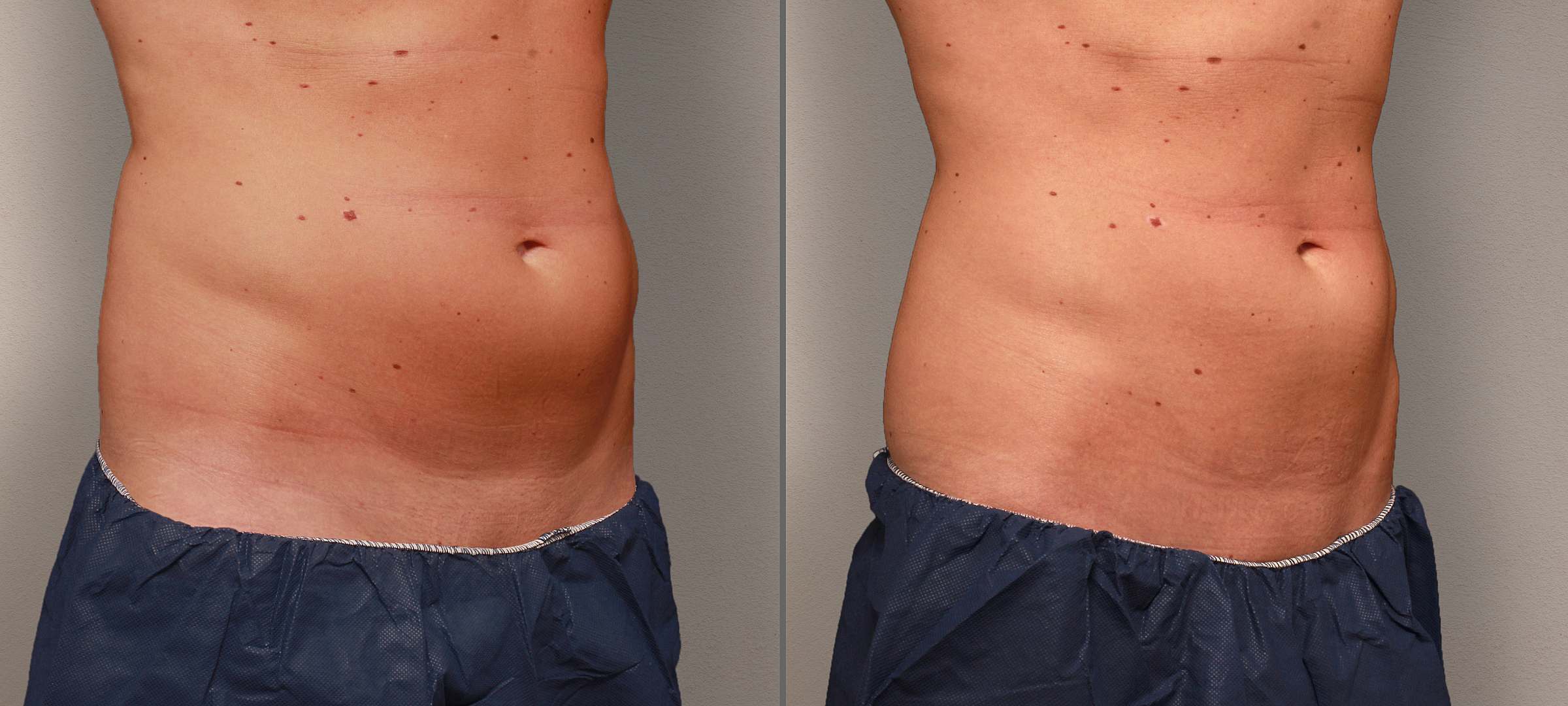 Smoothline CoolSculpting für Fettreduktion Kryolipolyse in Zürich