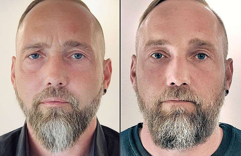 Vorher/Nachher-Aufnahmen eines Gesichts als Beispiel für den Wangenaufbau