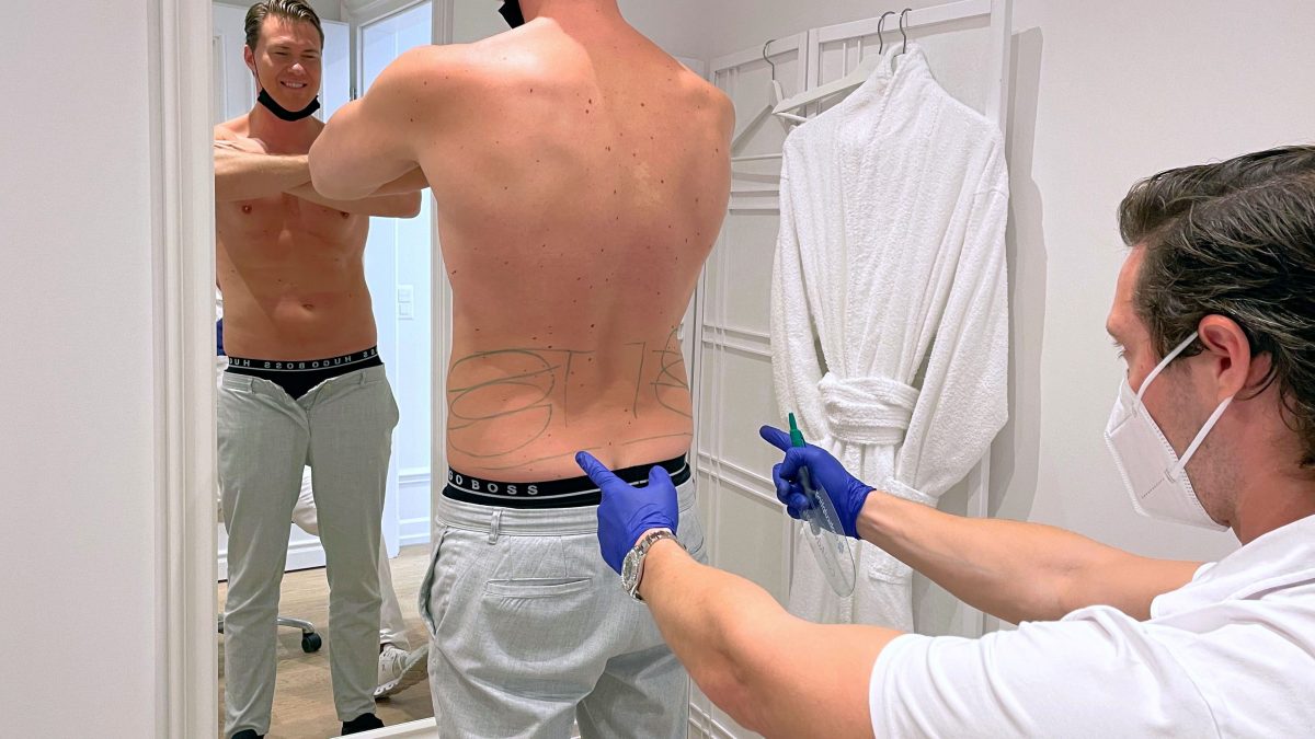 Photo during the check of the marked areas of the flank region before the CoolSculpting treatment at Smoothline