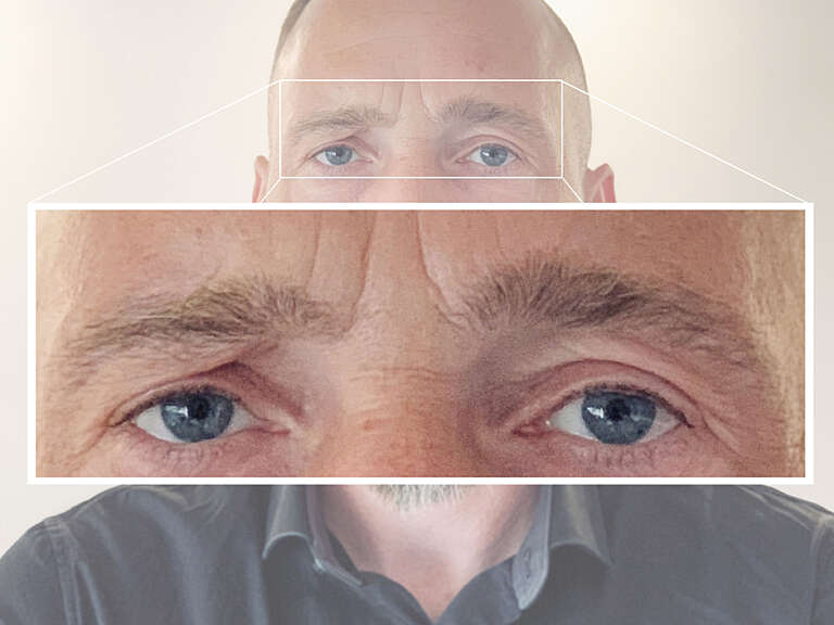 Photo with detailed section of Matthias' eye area before treatment of frown lines with botulinum toxin