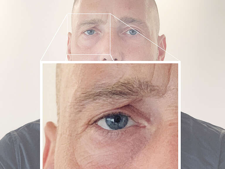 Photo detail of Matthias' eye area before treatment of his dark circles with hyaluronic acid filler at Smoothline