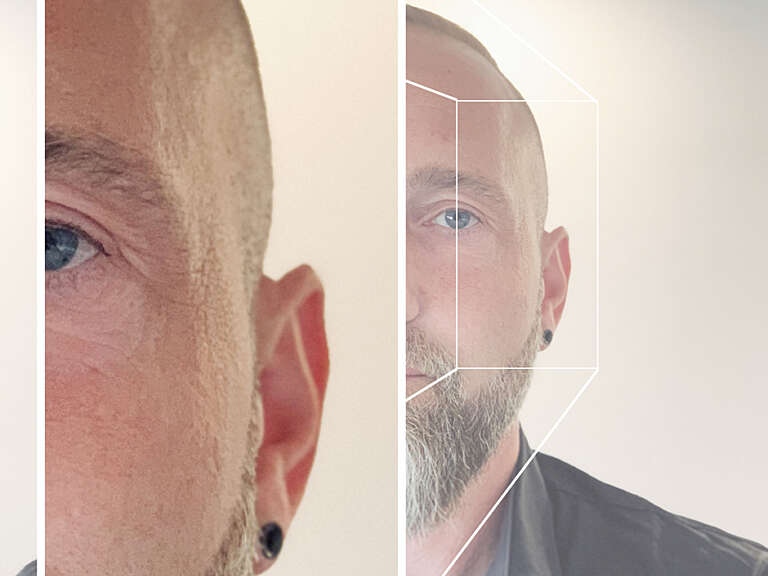 Photo detail of Matthias' temples and cheeks before volume loss treatment with filler